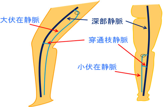 下肢静脈瘤