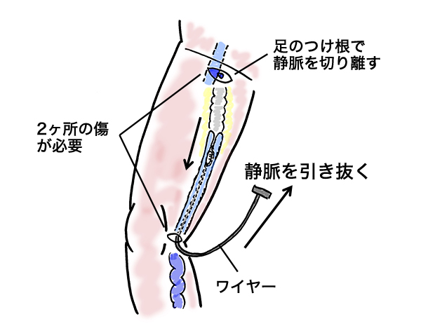 下肢静脈瘤